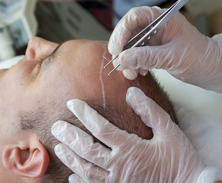 What You Should Know About Hair Restoration Procedures